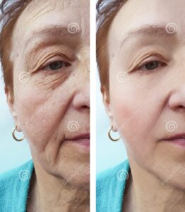 colágeno en la cara antes y después